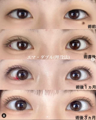 エマ・ダブル(埋没法) 