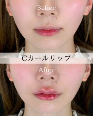 Cカールリップ