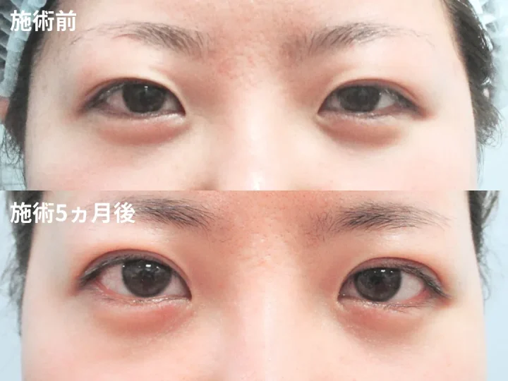 城本クリニック 二重術 症例写真