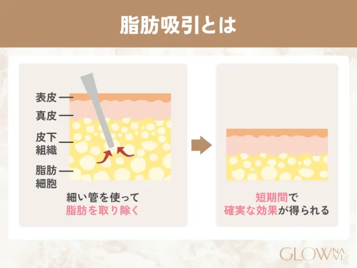 脂肪吸引とは