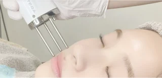 シミ取り (ピコスポット)