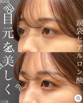 ヒアルロン酸フィラー