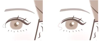 みきクリニック　二重