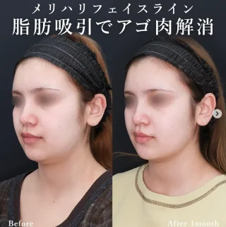 脂肪吸引(アゴ下)