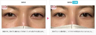 リジュランHB