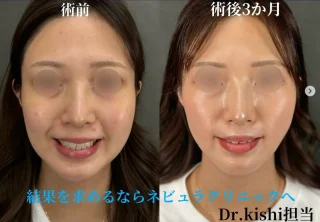 顔の脂肪吸引＋糸リフト