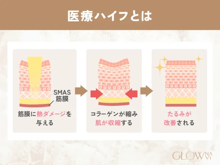 医療ハイフとは