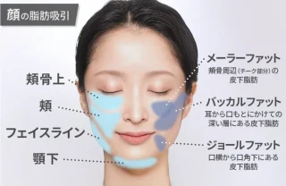 ジョウクリニック　脂肪吸引