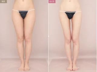 ベイザー脂肪吸引（太もも全周＋臀部）