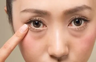 経結膜脱脂