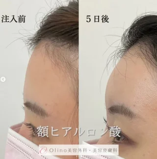 額ヒアルロン酸 入れ放題