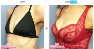 VASER併用旧ピュアグラフト（脂肪注入豊胸）