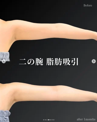 脂肪吸引(二の腕＋肩)