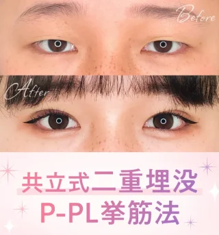 共立美容外科　二重整形