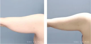 二の腕のベイザー脂肪吸引
