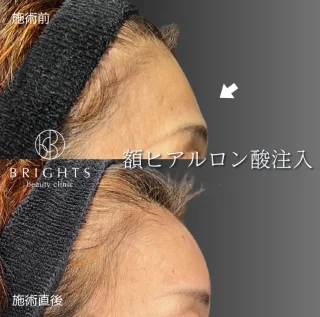 額ヒアルロン酸注入