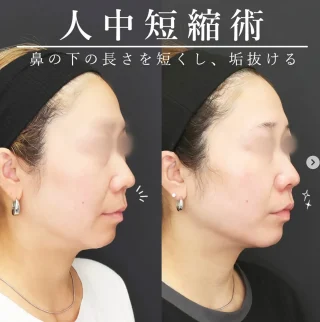 １day人中短縮術