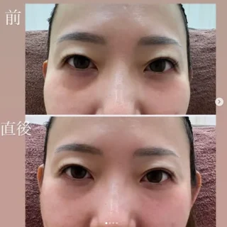 ヒアルロン酸注入（クマ消し）