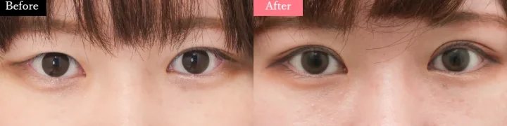 イセアクリニック 二重術 症例写真