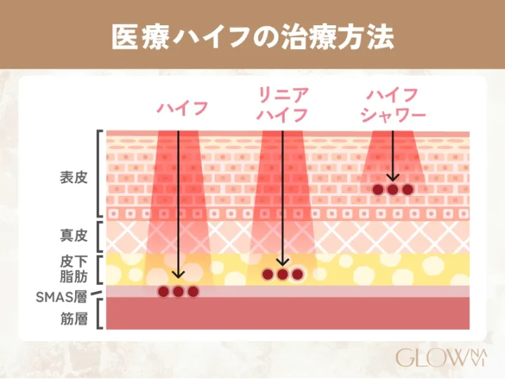 医療ハイフ(HIFU)の治療方法