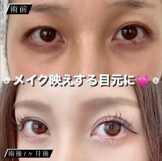 オーダーメイド二重整形