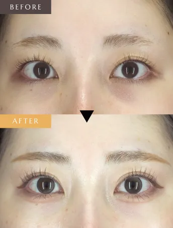 ルシアクリニック 二重術症例写真