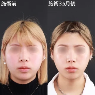 アゴ下の脂肪吸引/ボツリヌストキシン注射