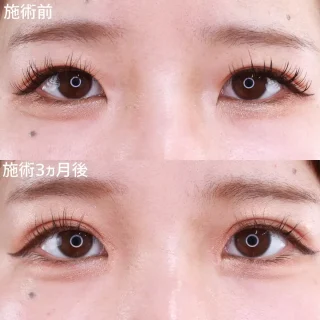 二重埋没法1dayナチュラルデザイン4点留め＋目頭切開術
