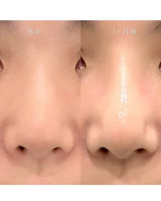 鼻尖形成