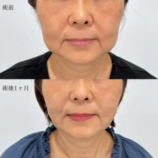エラのボトックス小顔注射