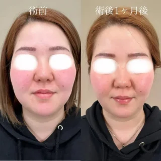 顔の脂肪吸引