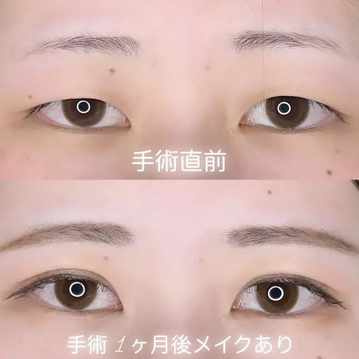 カンナム美容外科 二重症例写真