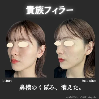 貴族フィラー(ボラックス)