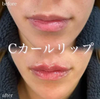 Cカールリップ（ボルベラ）