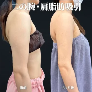 脂肪吸引(二の腕・肩)