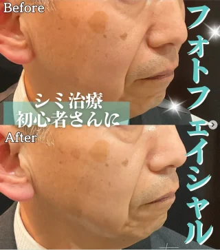 フォトフェイシャル(顔)