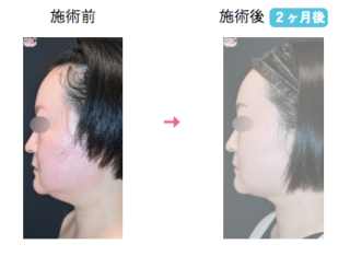 小顔用脂肪吸引注射