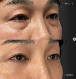切らない目の下のクマ取り・たるみ取り