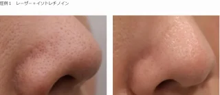 イソトレチノイン