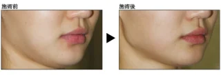 HIFU