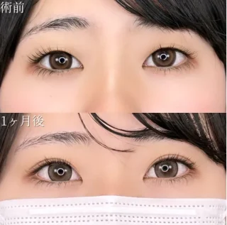 まぶたの脂肪取り＋二重埋没法