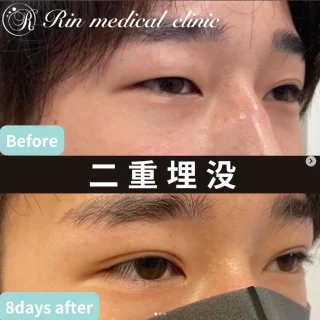 二重埋没法