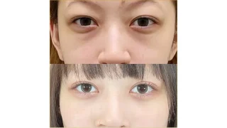 目の下のクマ・ふくらみ取り