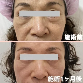 経結膜アプローチ法