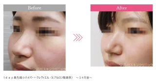1ｄａｙ鼻先縮小ハイパー＋クレヴィエル（ヒアルロン酸鼻筋）