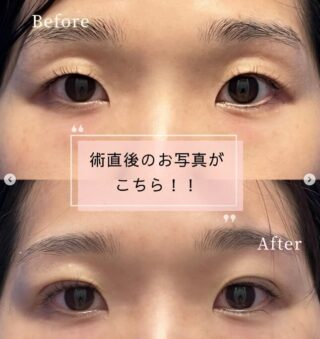P-PL挙筋法 GOLD LONG MORE