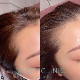 ヘアラインアートメイク