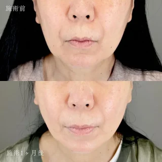 小顔美肌再生（リフトアップ）