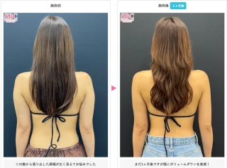 Aquicell（アキーセル）脂肪吸引