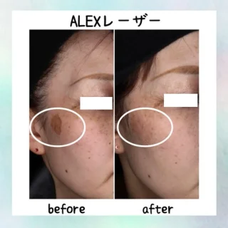ALEXレーザー